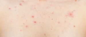exfoliation_acne