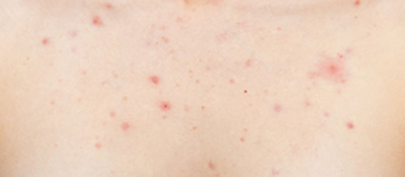 exfoliation_acne