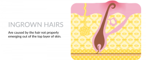 Ingrown-Hairs